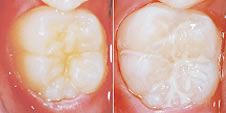 予防歯科1